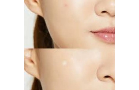 Parches cosrx acne pimple master patch comprar en tienda online michii cosmética coreana en España